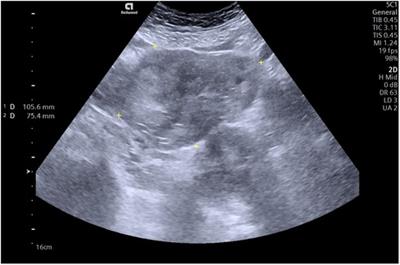 Case report: Ectopic pregnancy in the interstitial part of the fallopian tube